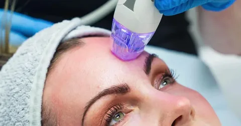 RF Microneedle Machine: A Modern Solution for Advanced Skin Treatments